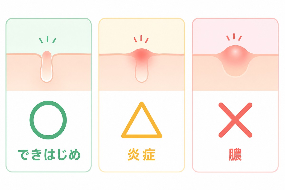ニキビの状態別にパッチの向き不向きを整理した早見表の図