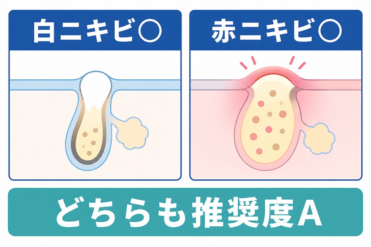 白ニキビと赤ニキビの両方に推奨度Aが付くことを示す図解