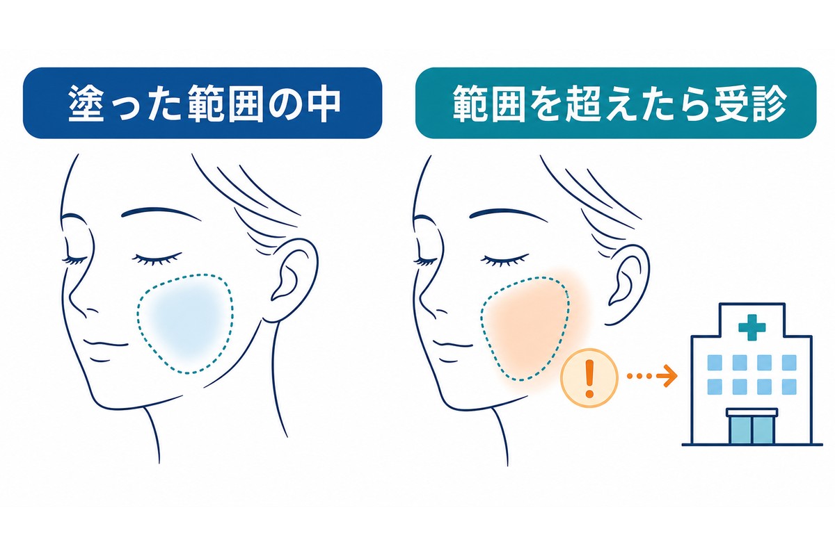 通常の刺激とかぶれの違いを見分けるポイントを示す図解