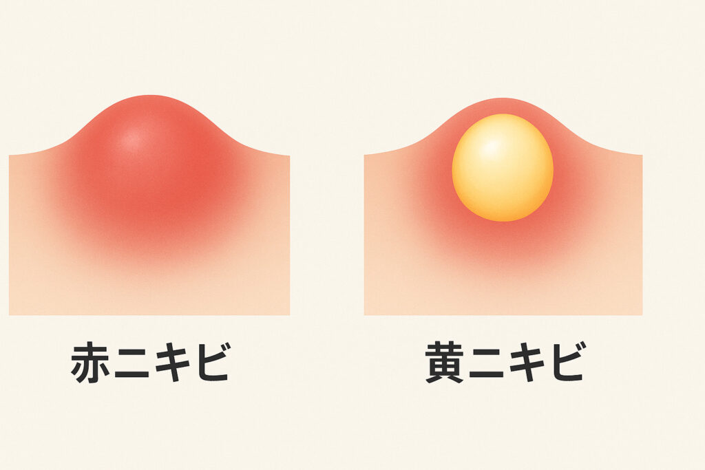 inflammatory-acne-care